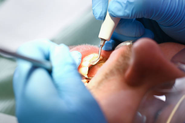 Best Emergency Tooth Extraction in Dunkirk, IN