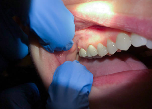 Best Emergency Dental Care for Broken or Chipped Teeth in Dunkirk, IN
